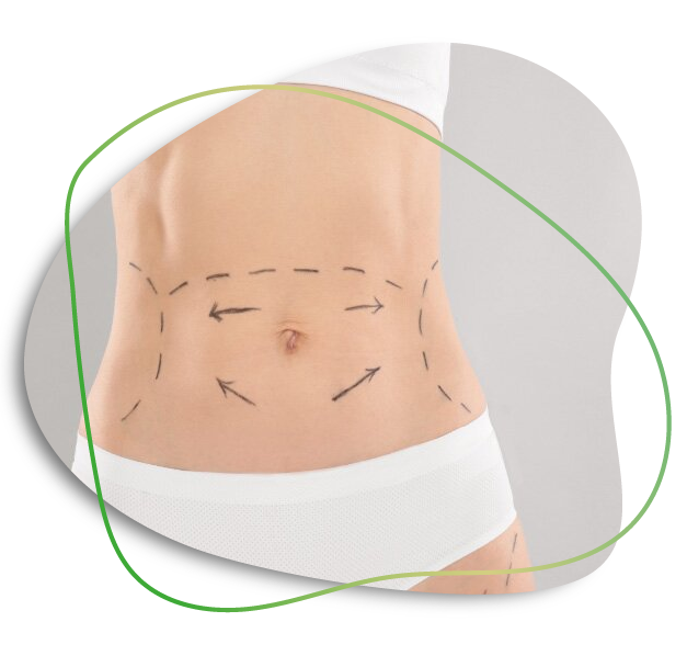 Abdomen Liposuction