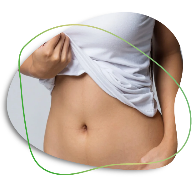 Mini Abdominoplasty In Dubai