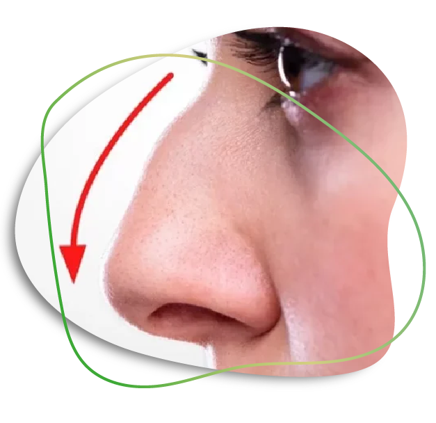 Septoplasty In Dubai